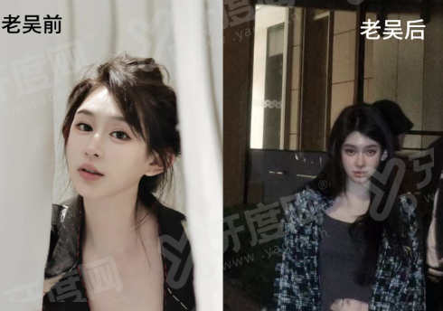 二、陈雄医生做双眼皮的技术特色与收费明细是怎样的？yanke.yadoo.cn