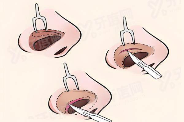 北京叶子医疗美容医院唐龙鼻修复怎么样？唐龙院长高难度修复技术精湛重塑自然美鼻