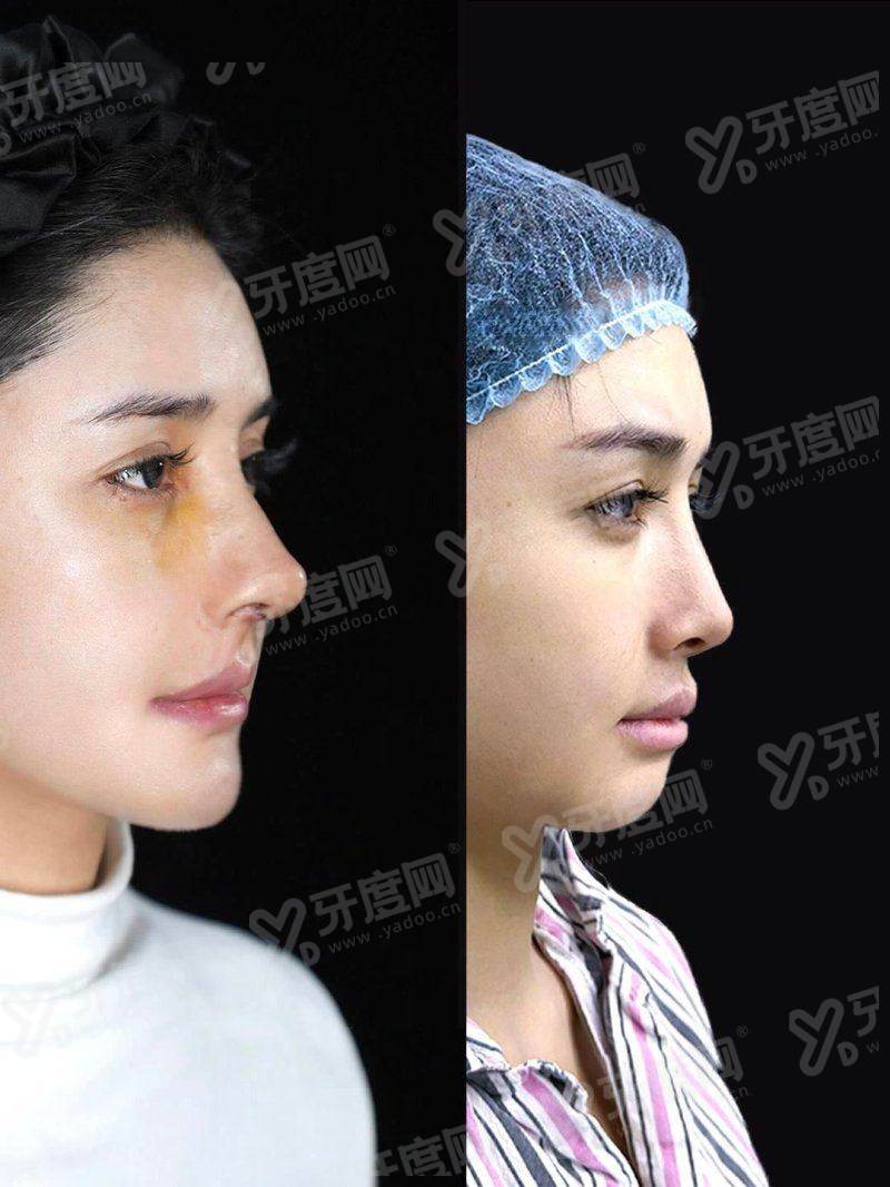 广州李方伟医生口碑评价真有那么好？擅高难鼻修复审美在线，术后指导细致口碑佳。