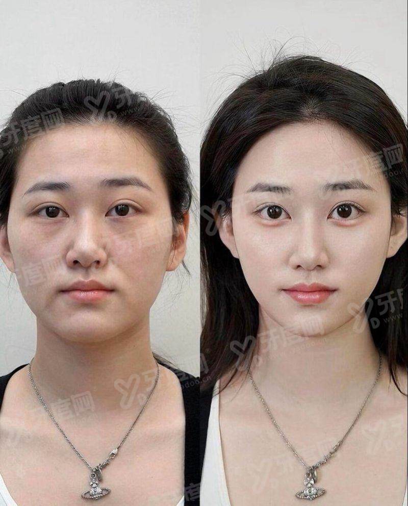 (一)韩国alive皮肤科抗衰紧致项目价格表:热玛吉FLX价格起/超声提拉价格起/Onda微波溶脂价格起