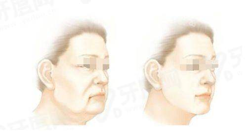 二、北京加减美面部提升价格表是什么怎么样？yanke.yadoo.cn