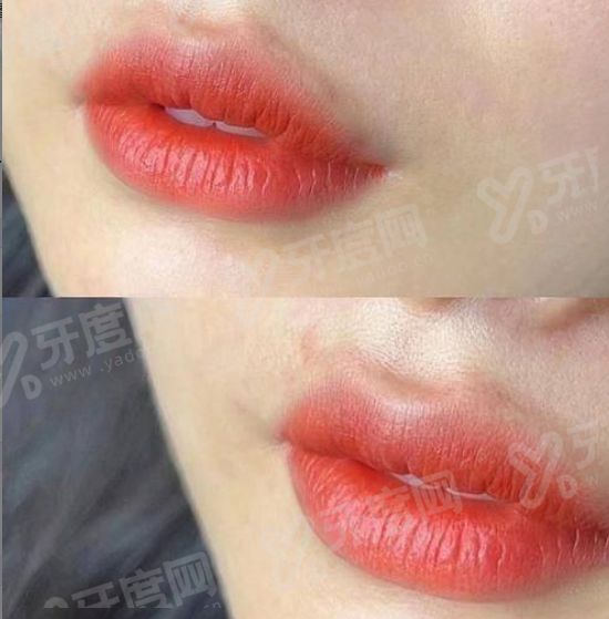 二、广州广大颧骨颧弓整形好怎么样?yanke.yadoo.cn