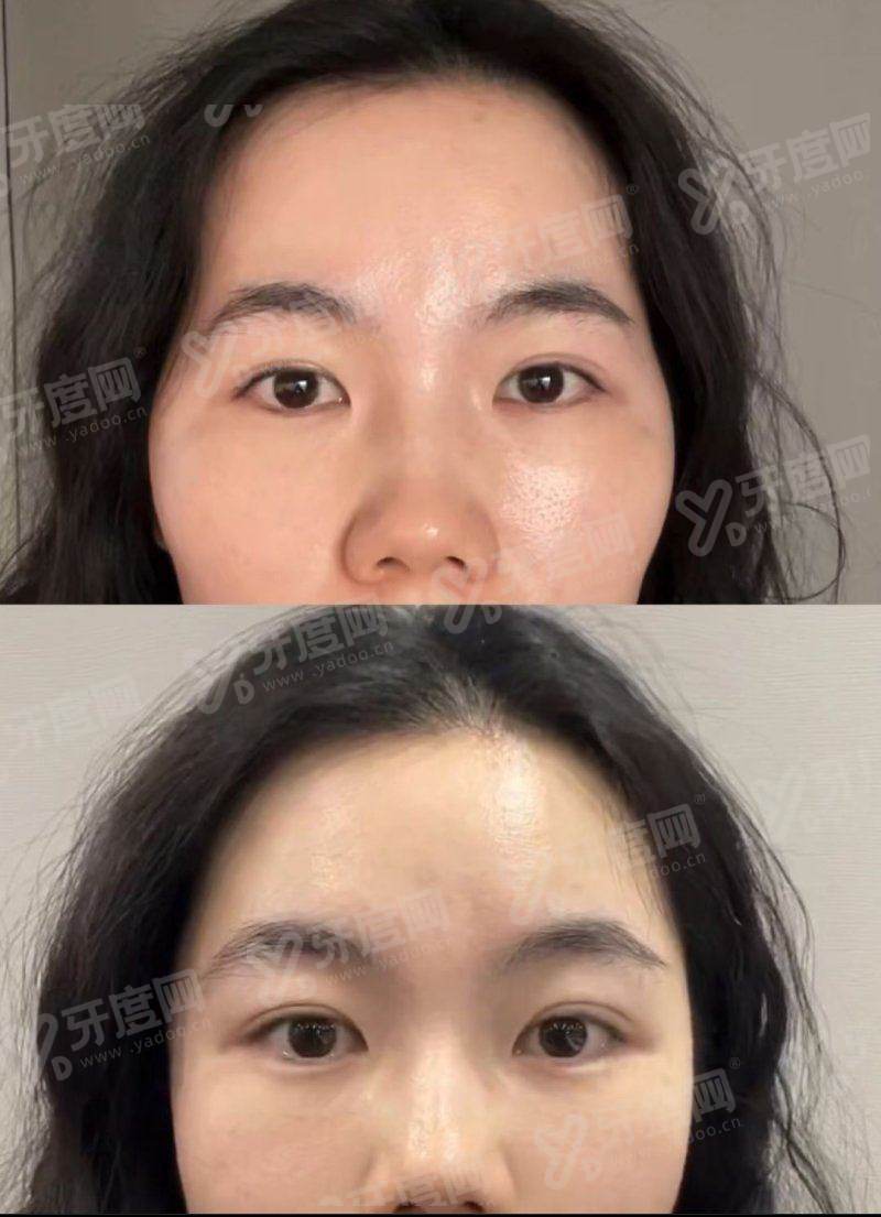 北京碧莲盛植发毛发种植怎么样？存活率高密度自然，查价格路线上甜伊严选小程序