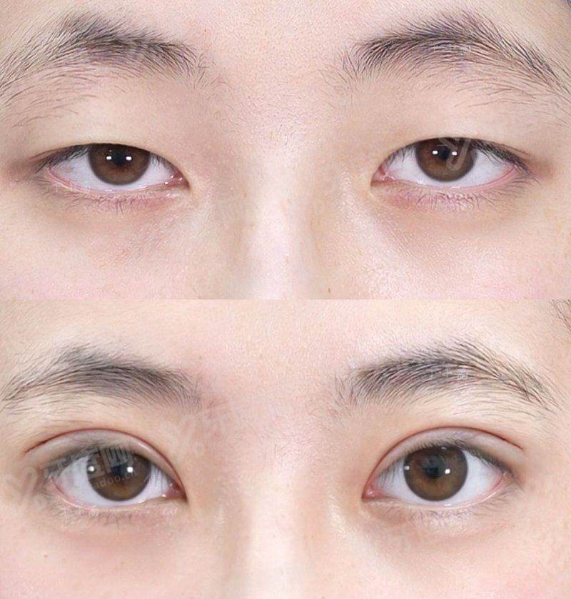 二、上海首尔丽格双眼皮价格怎么样？yanke.yadoo.cn
