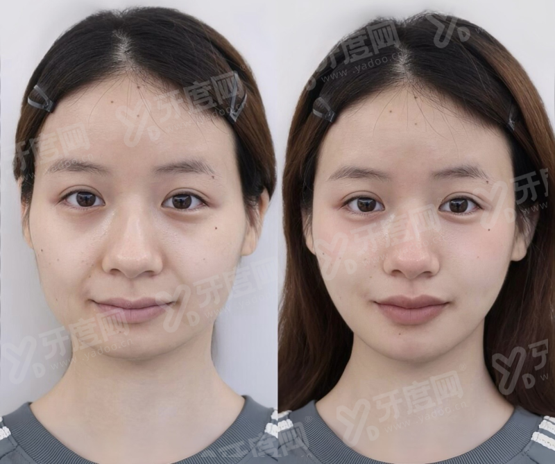 二、广西 南宁华美整形医院英伦大提升好怎么样？yanke.yadoo.cn