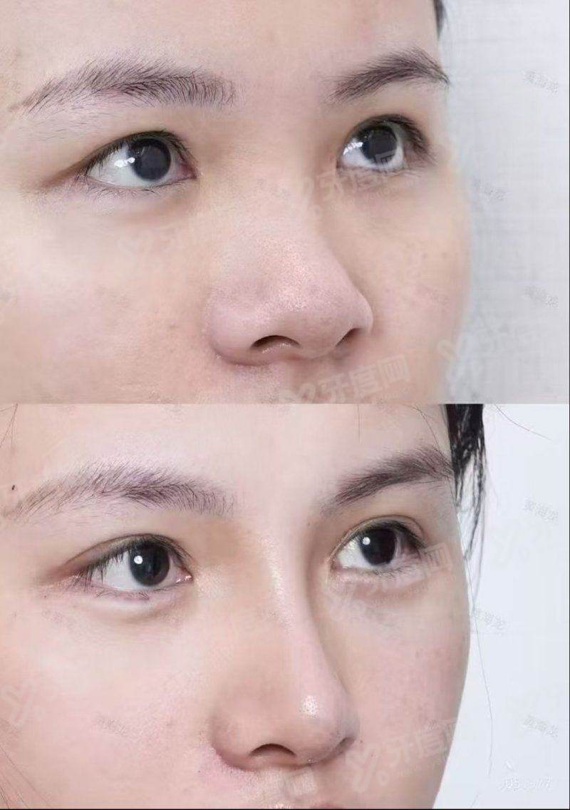 北京美莱医疗美容注射整形好？自然灵动显年轻，上甜伊严选小程序轻松预约变美！