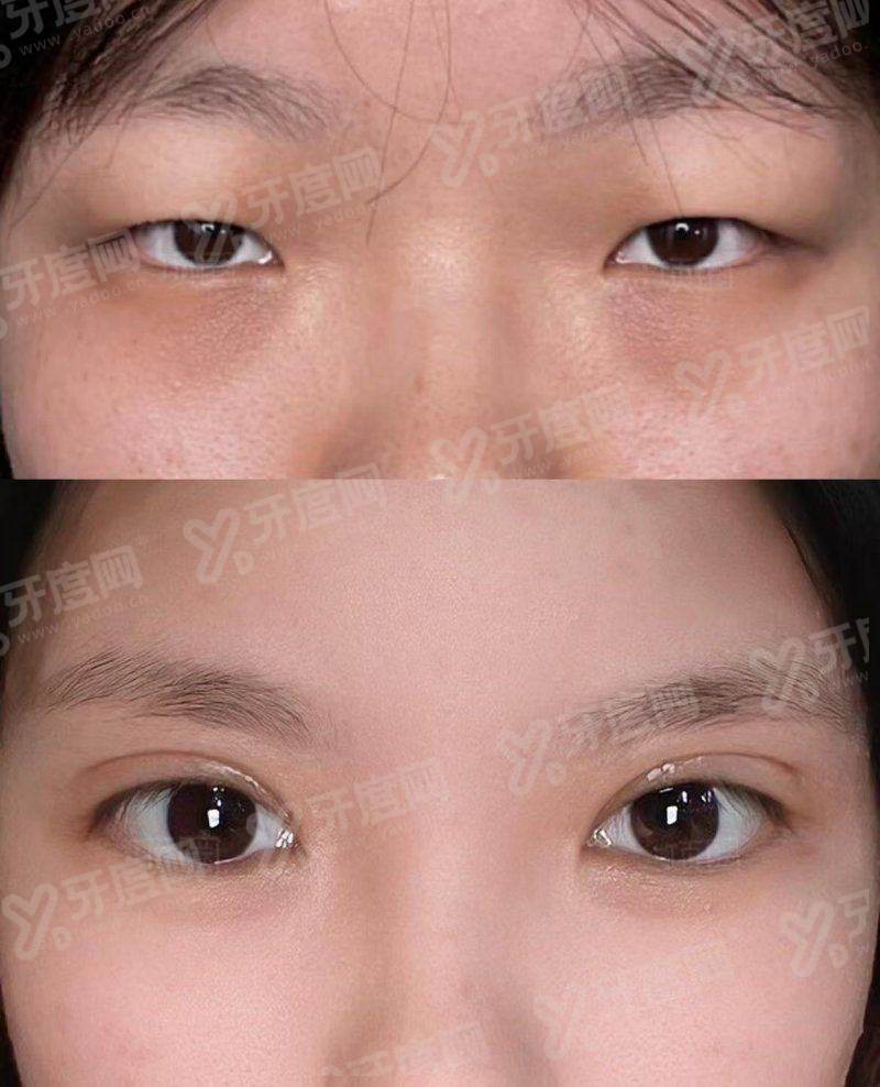 二、北京美莱医疗美容注射整形好怎么样?yanke.yadoo.cn