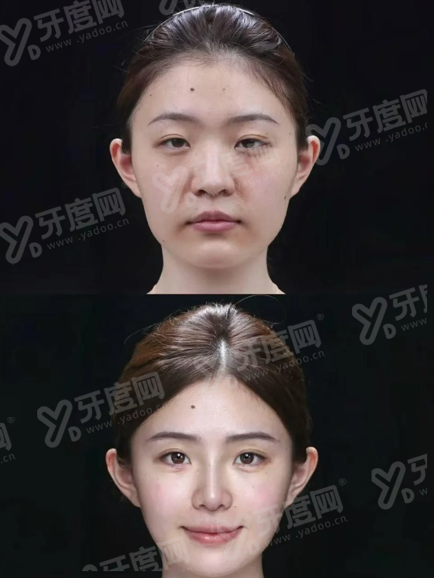 二、广东佛山美莱整形胶原蛋白不贵怎么样?yanke.yadoo.cn