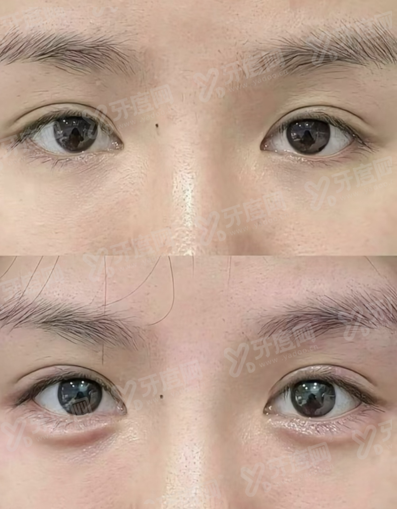 二、郑州缔莱美整形隆鼻修复好怎么样?yanke.yadoo.cn