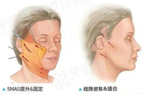 二、杭州艺星莫纳丽莎玻尿酸怎么样?上甜伊严选预约怎么样?yanke.yadoo.cn