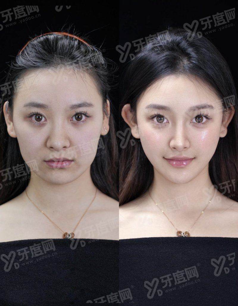 二、深圳美莱超皮秒水光怎么预约?上甜伊严选预约怎么样?yanke.yadoo.cn