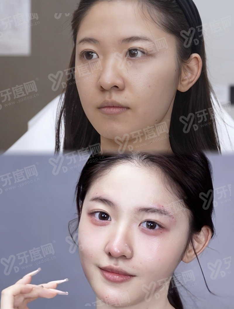 一、北京嘉禾整形双眼皮实例多吗?上甜伊严选预约yanke.yadoo.cn
