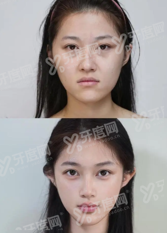 泸州泸美时光里黄金超光子价格？上甜伊严选预约单次千元起，效果惊艳，速查优惠！