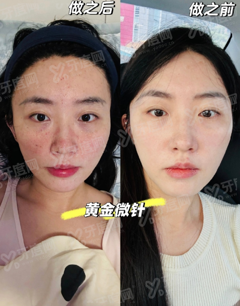 二、济南韩氏整形针剂注射怎么预约|怎么联系医院预约针剂注射上甜伊严选一键预约,预约流程更简单怎么样?yanke.yadoo.cn