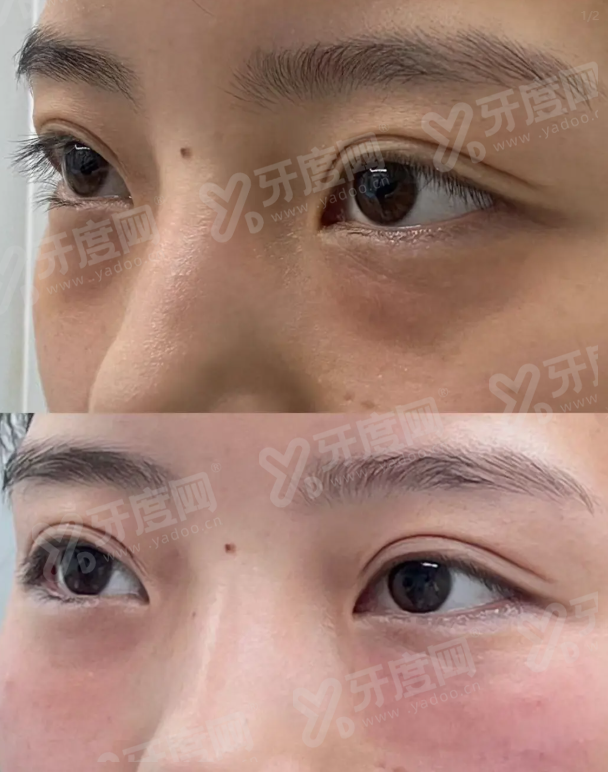 二、北京美莱医疗美容爱贝芙注射隆鼻怎么预约|怎么联系医院预约爱贝芙注射隆鼻上甜伊严选一键预约,预约流程更简单怎么样?yanke.yadoo.cn
