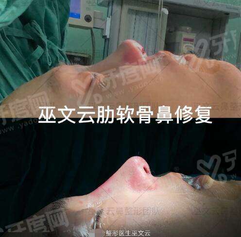北京米扬丽格巫文云隆鼻修复怎么预约？甜伊严选一键查医师资质与鼻修复技术，32 年院长云梯式重建稳。