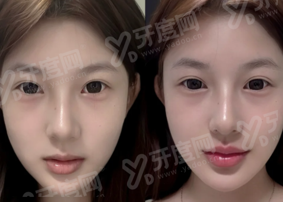 韩国圣水melting皮肤科抗衰项目解析，韩版超声刀舒丽可，首尔Eonni可直接提交预约需求？紧致提升快，搭配极光安瓶更亮白，一键查询优惠！
