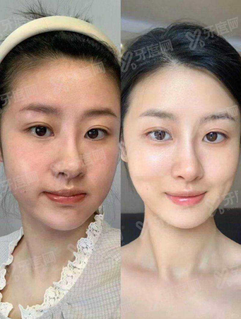 二、釜山西面 Dr.Evers 腹部&手臂溶脂针怎么约，首尔 Eonni 省去韩语沟通麻烦怎么样？yanke.yadoo.cn