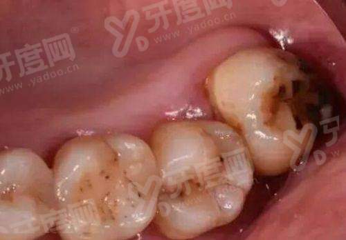 二、哈尔滨美植口腔种植牙术后修复真实评价yanke.yadoo.cn