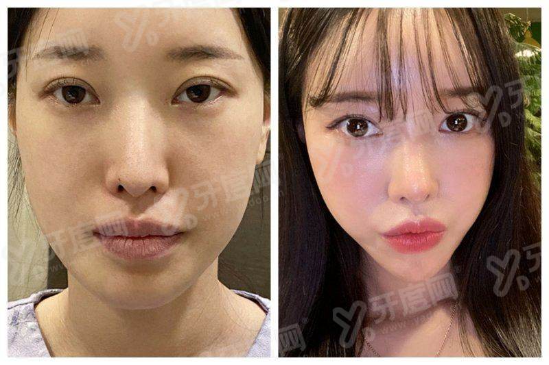 二、清潭 ruby 抗衰除皱价格多少?首尔 Eonni 告知法定渠道怎么预约怎么样?yanke.yadoo.cn