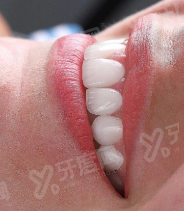 二、北海海豚口腔种植牙口碑怎么样?真实实例见证重拾口福的喜悦yanke.yadoo.cn