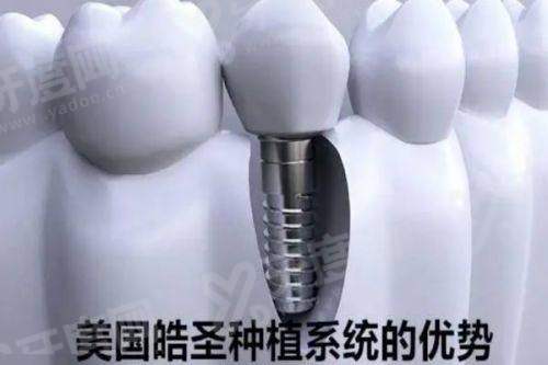 上海鼎植口腔收费价格表2026：种植牙 3980 起，黎强医生亲诊让缺牙重生更安心