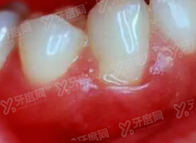 北京禾禾口腔半口种植多少钱？约 4 万起含儿童矫正，种牙价格透明放心选