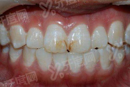 二、重庆牙博士口腔矫正实例真实分享:3D 模拟精细预测,宝妈亲测避坑指南yanke.yadoo.cn