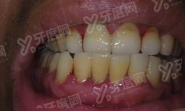 二、成都新桥口腔半口种植牙多少钱yanke.yadoo.cn