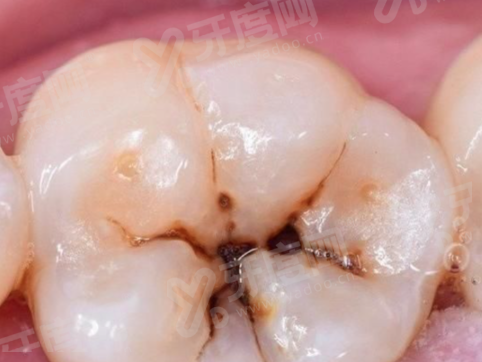湘潭贝壳口腔种植牙价格表 2026 最新：单颗 2980+隐形矫正 1.68 万起