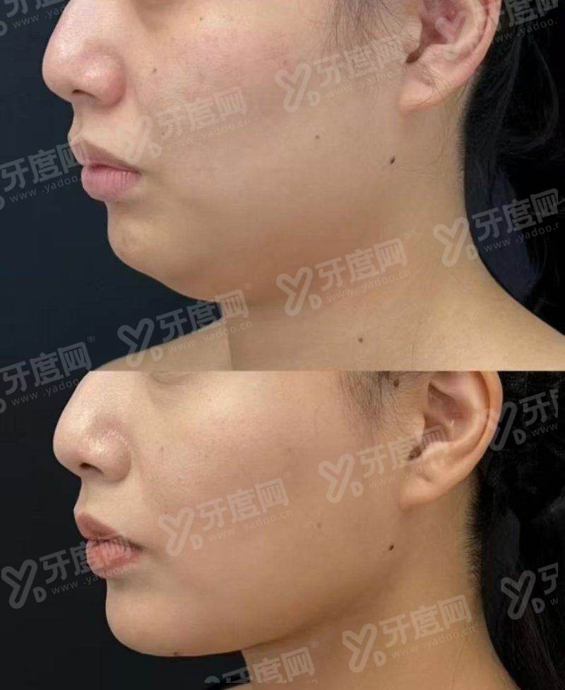 三、韩国 Petit 皮肤科热门项目价格透明吗?明码标价杜绝隐形消费让每一分钱都花得值yanke.yadoo.cn