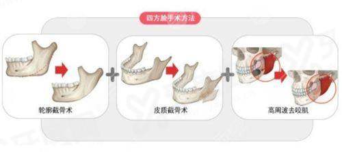 三、韩国 CNP 皮肤科热门项目价格参考与院区分布详解yanke.yadoo.cn