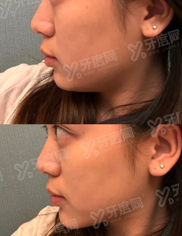 三、去BAIDClinic做医美大概需要多少预算?近期有哪些优惠活动?yanke.yadoo.cn