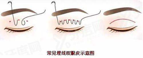 三、韩国 BTN 皮肤科价格是否透明?中韩同价政策让每一分钱都花在刀刃上yanke.yadoo.cn