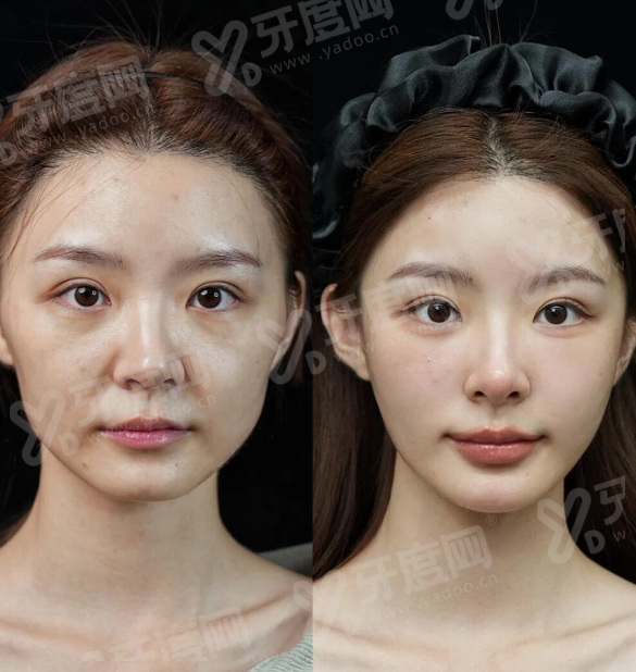 三、为什么选择本思皮肤科能让您的医美旅游体验更上一层楼？yanke.yadoo.cn