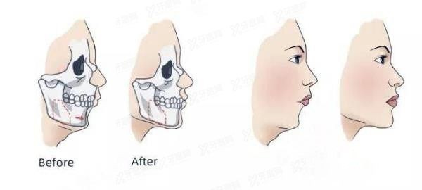 想做正畸但是正畸医生让我做正颌手术这是为什么?看正颌和正畸的区别！.jpg