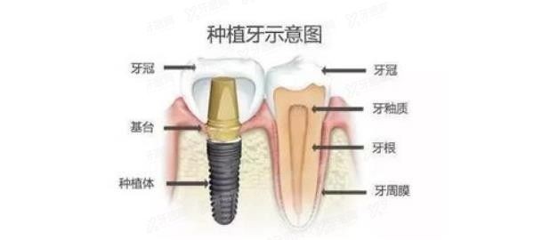 广大医院376元种牙是真的吗？广州广大医院种植牙便宜可靠！.jpg