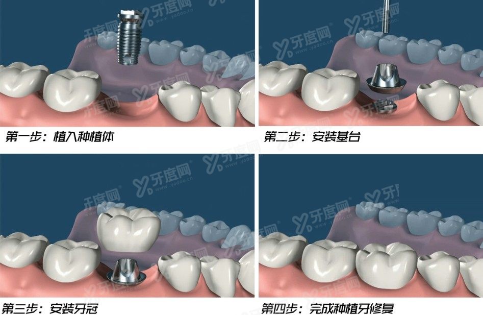 绍兴柯桥牙科医院詹传华医生www.yadoo.cn