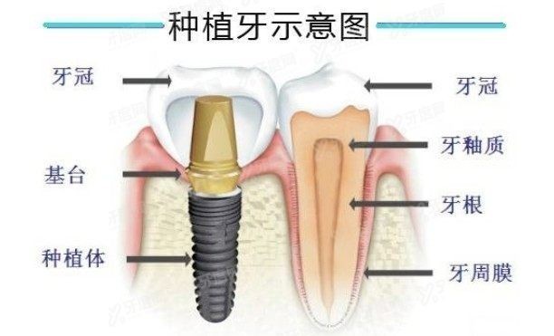 做种植牙后可以做核磁共振吗？www.yadoo.cn