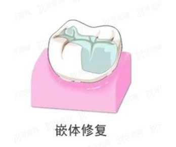 根管治疗做牙冠还是嵌体好www.yadoo.cn