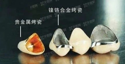 烤瓷牙多少钱一颗价格表2024www.yadoo.cn