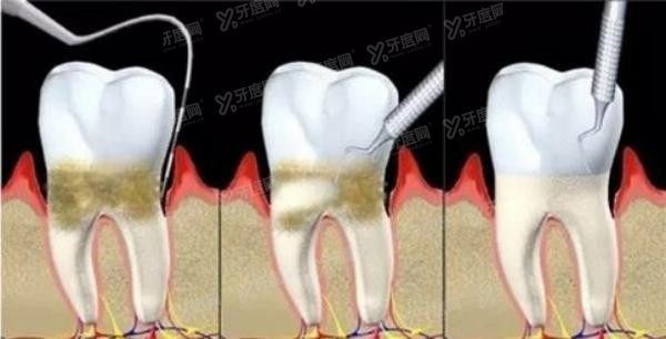 牙周的治疗方法：用（喷）药、牙周刮治或激光治疗，以及牙周手术。.jpg