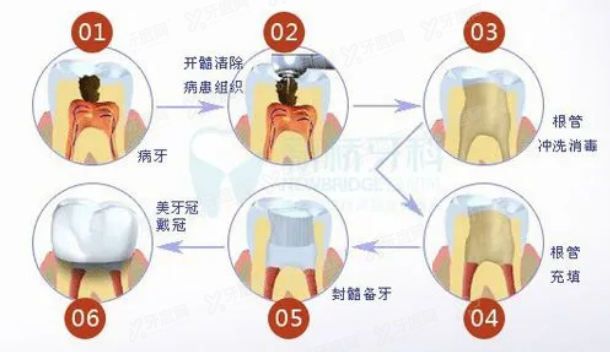 老年人根管治疗www.yadoo.cn.jpg