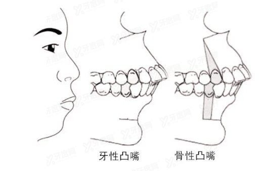 廣東人嘴凸比較多？