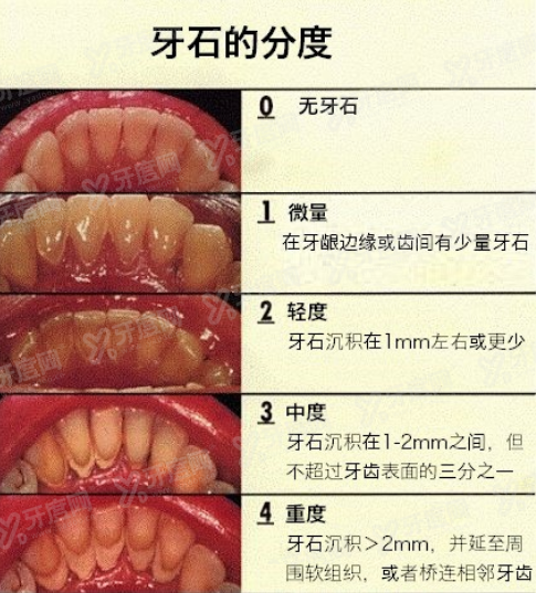 牙结石.jpg