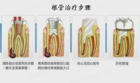 深龋时做根管治疗有什么优势？www.yadoo.cn