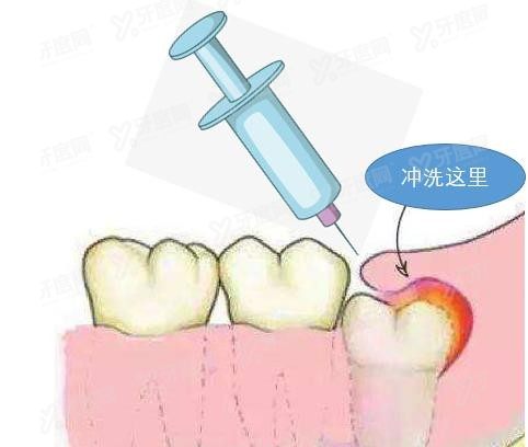 冠周冲洗的方法