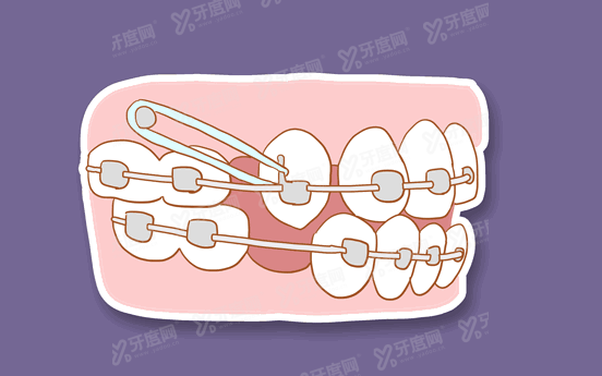 牙齿矫正.jpg
