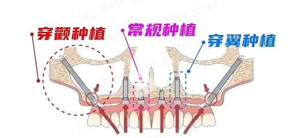 穿颧骨种植牙要多少钱m.yadoo.cn