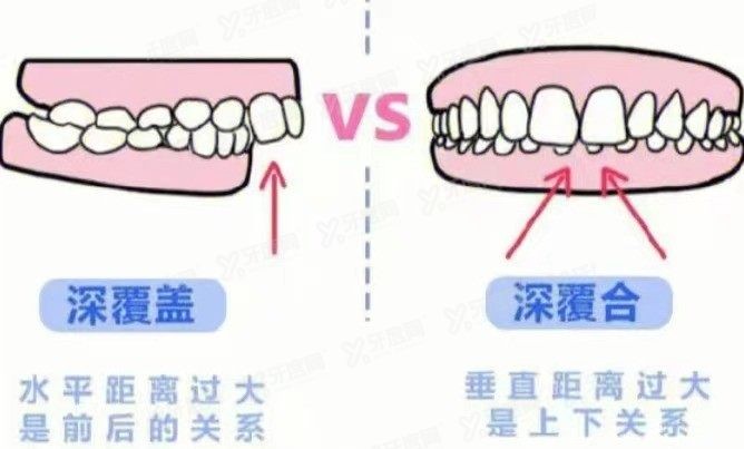 深覆合和深覆盖区别在哪里www.yadoo.cn